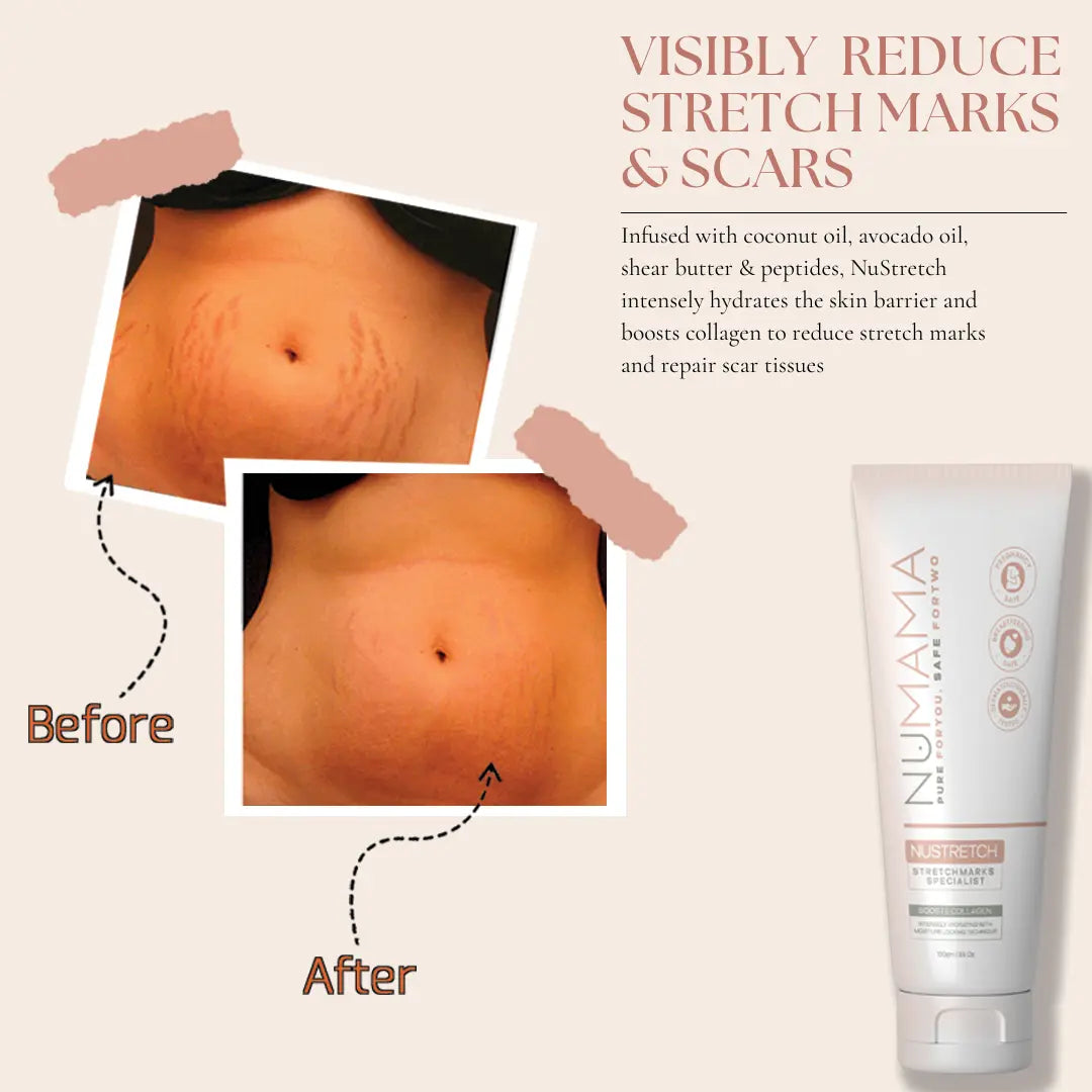NuStretch ~ The Stretch Marks Specialist (50g)